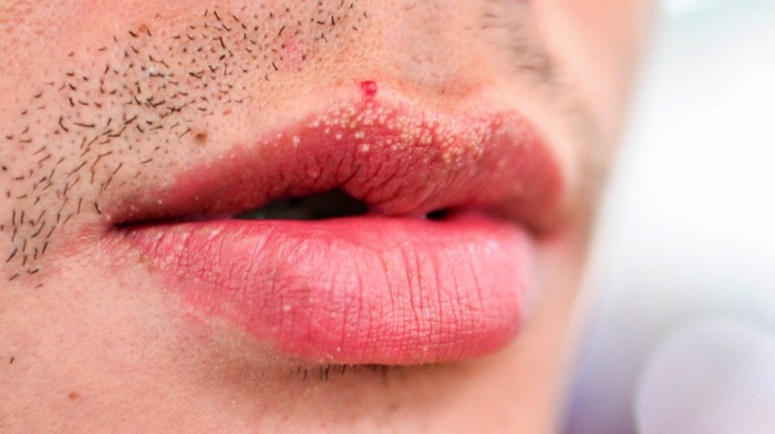 Bosses ou taches blanches sur les lèvres