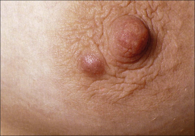 Les glandes de Montgomery