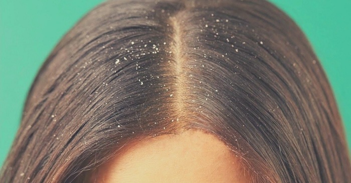 huiles essentielles pour les pellicules