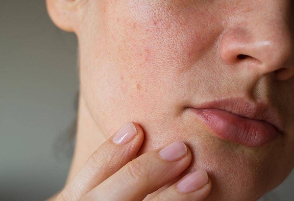 remèdes pour rétrécir minimiser les pores naturellement