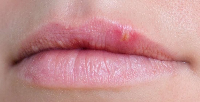 Bosses sur les lèvres