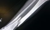 Images radiographiques de la fibula tibiale fracturée