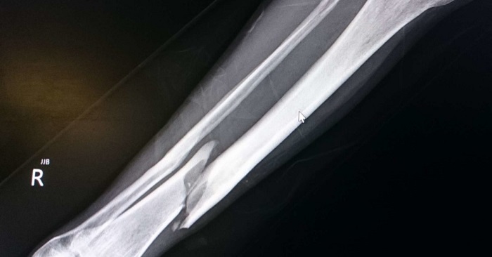 Images radiographiques de la fibula tibiale fracturée